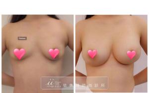 台南隆乳手術