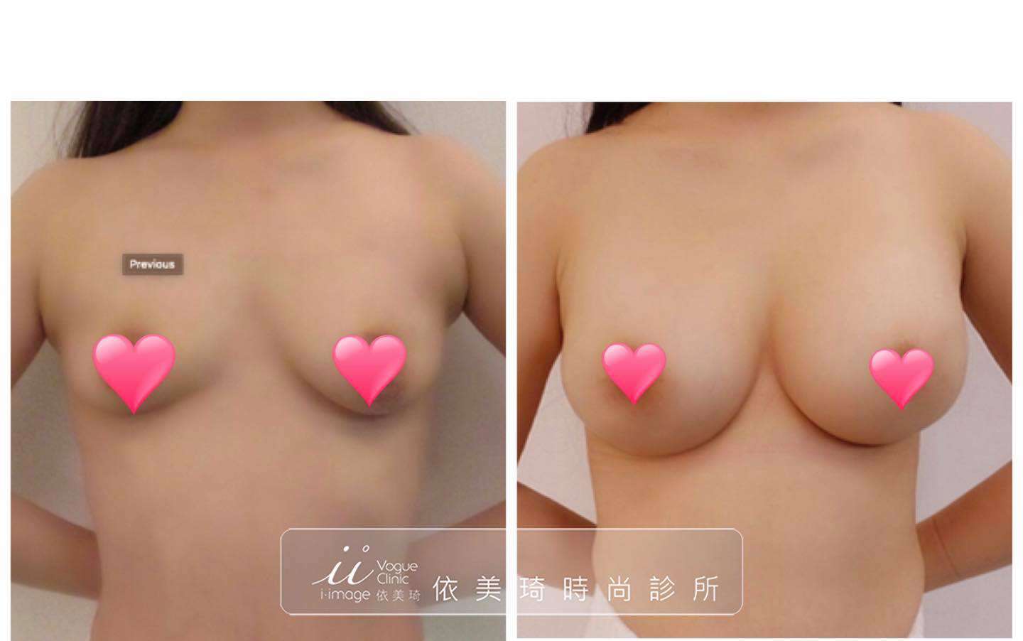 內視鏡隆乳手術後一年