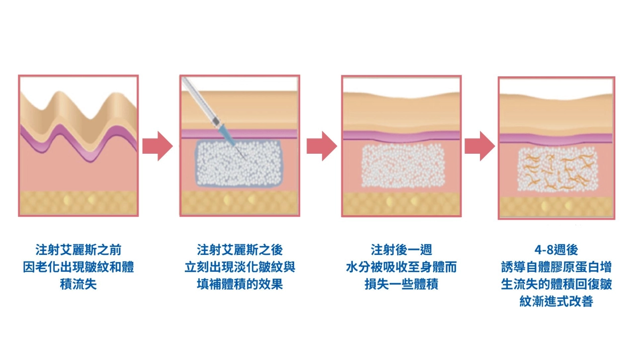 精靈針作用機制3