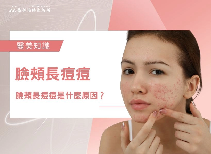 【臉頰長痘痘】臉頰長痘痘是什麼原因？臉頰的痘痘怎麼消？