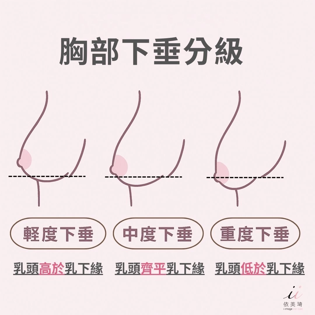 胸部下垂分級