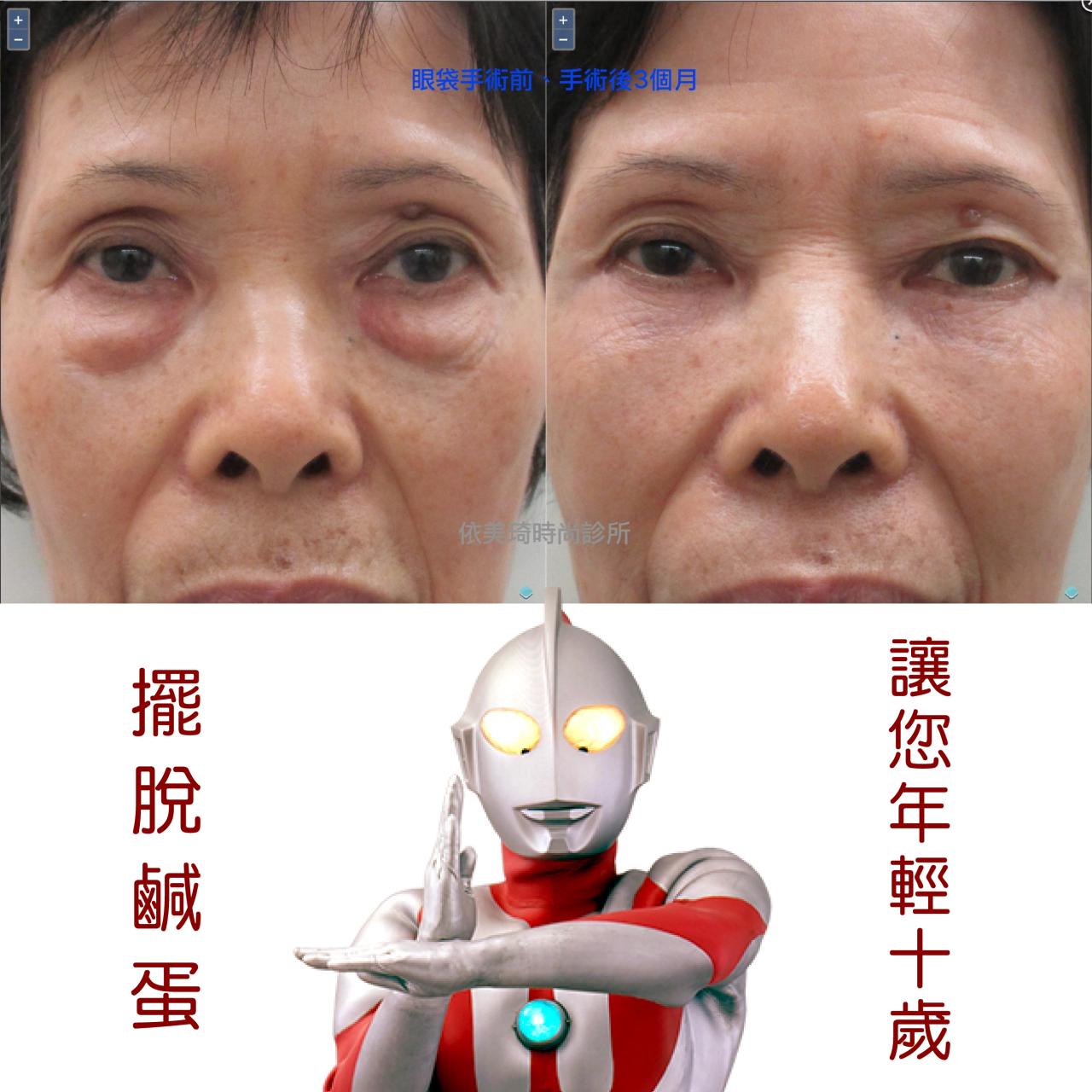 70歲阿嬤,擺脫鹹蛋(眼袋)台南眼袋推薦
