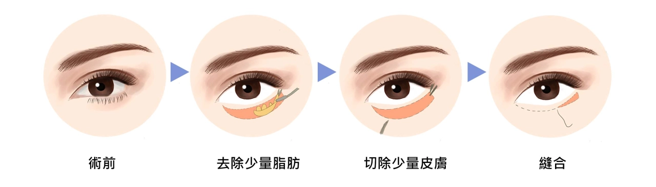 外開眼袋手術過程