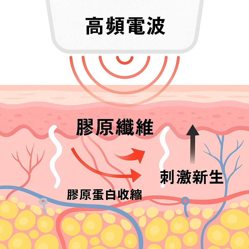 電波拉皮原理