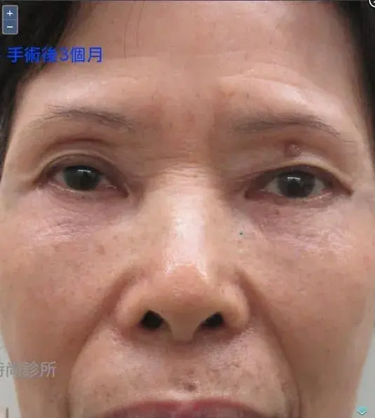 70歲阿嬤，擺脫鹹蛋（眼袋）手術3個月後