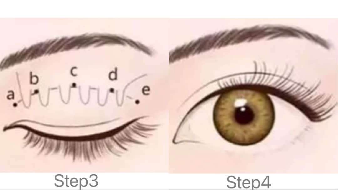 雙眼皮手術方式