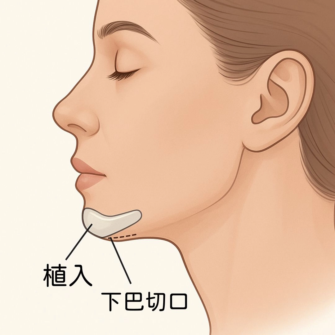 下巴外開手術