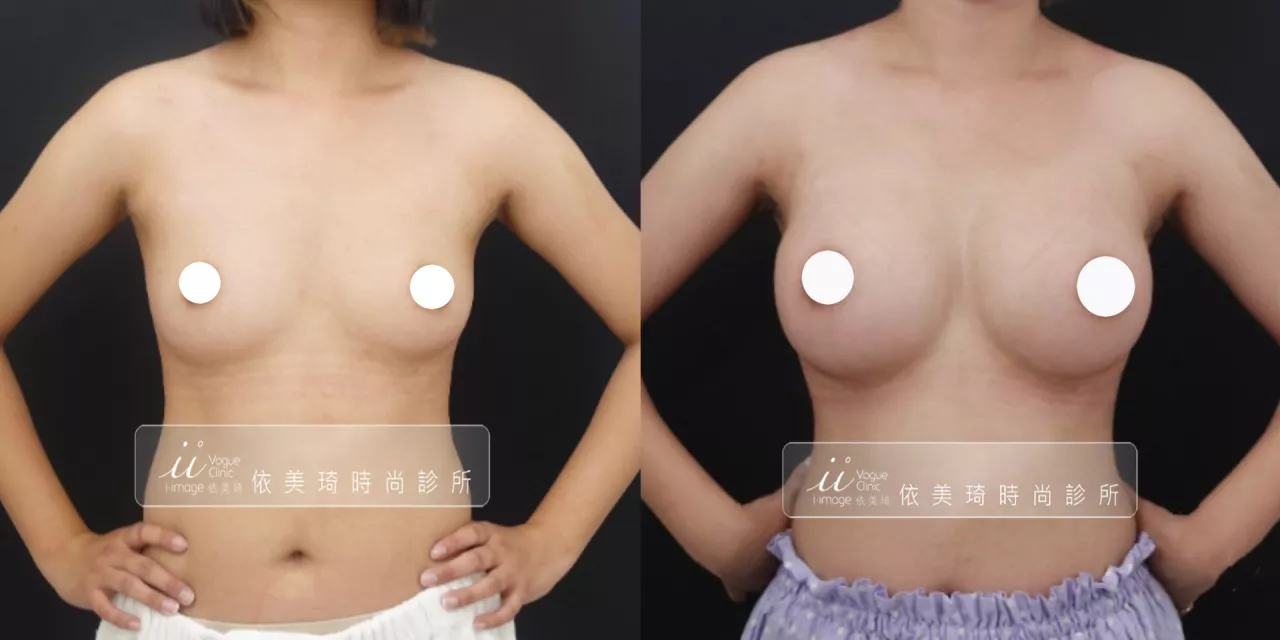 台南隆乳術後效果-曼陀女王波隆乳假體