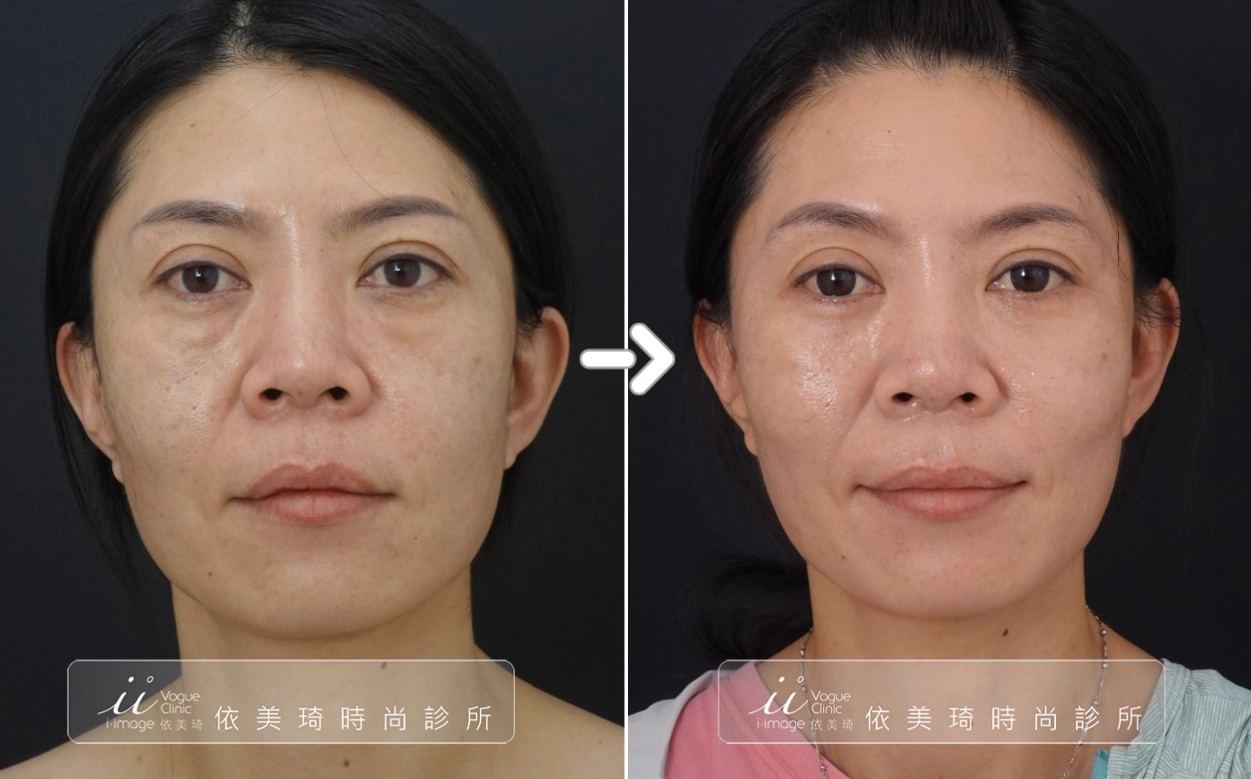 眼袋內開手術案例