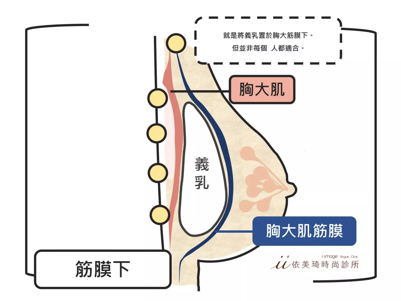 隆乳假體放置筋膜下位置|隆乳手術多少錢？｜隆乳手術危險嗎？｜隆乳手術前注意事項｜隆乳術後照顧｜隆乳手術過程