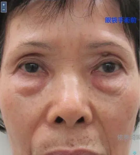 70歲阿嬤，擺脫鹹蛋（眼袋）手術前