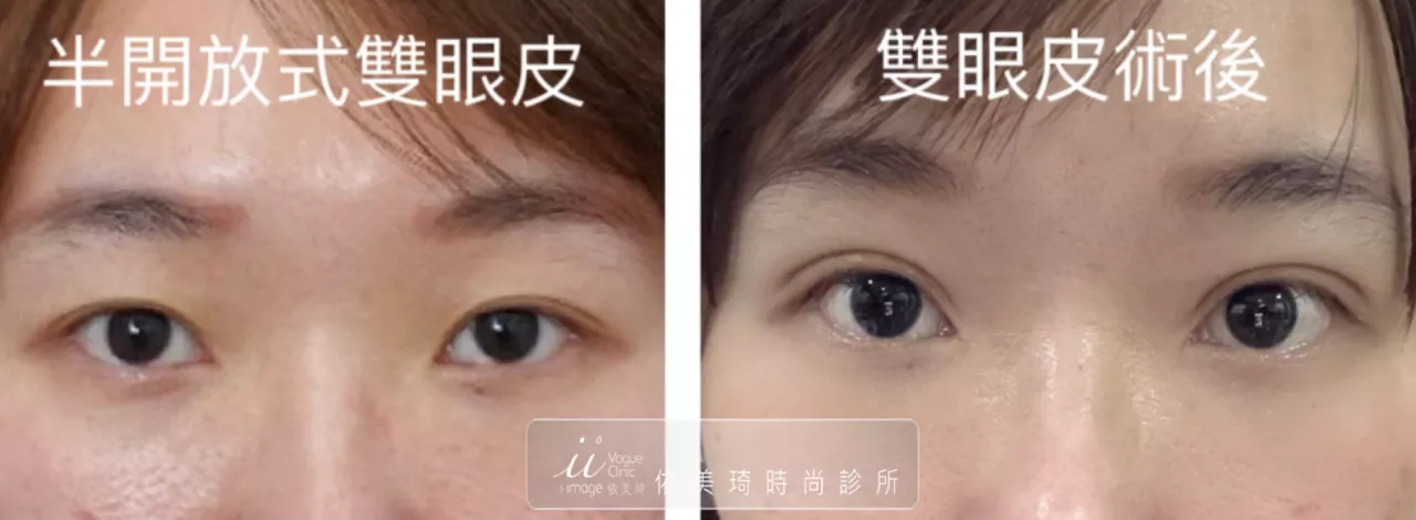 半開放式雙眼皮
