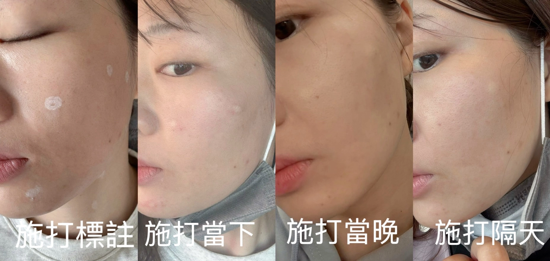 Profhilo 逆時針施打方式與術後狀況