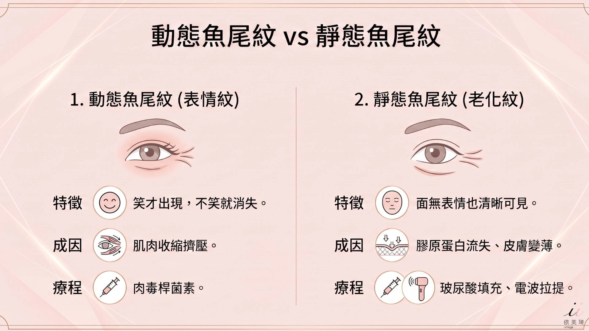 魚尾紋 vs 笑尾紋差在哪