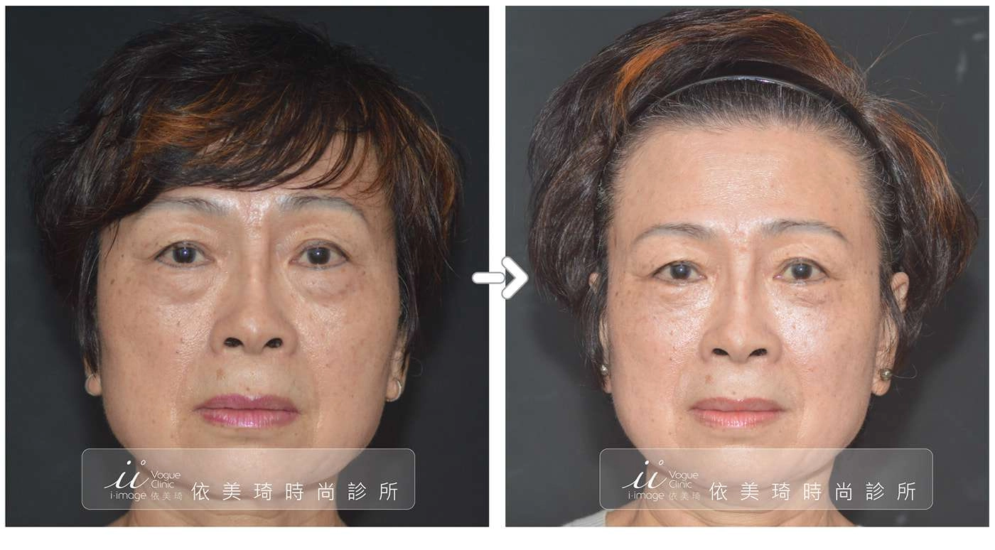 眼袋案例分享