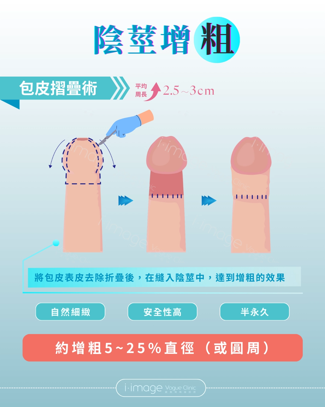 陰莖增粗：包皮摺疊術