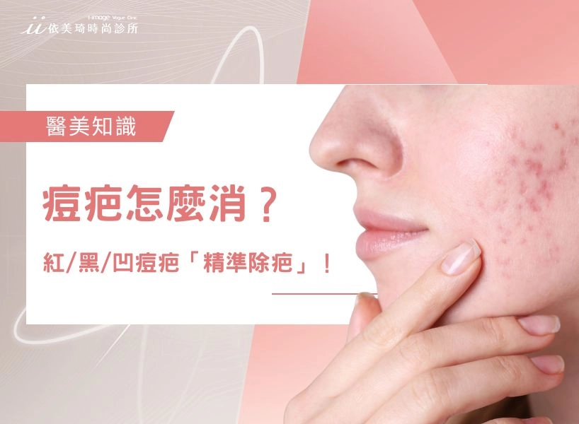 痘疤怎麼消？從紅、黑痘印到凹洞，醫師教妳「 精準除疤 」不踩雷！	