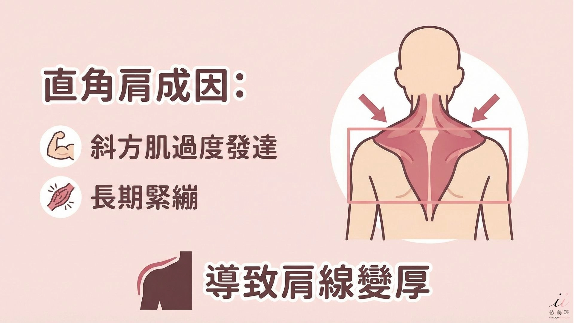 直角肩常見原因是斜方肌過度發達或長期緊繃，把肩線「 撐厚 」了