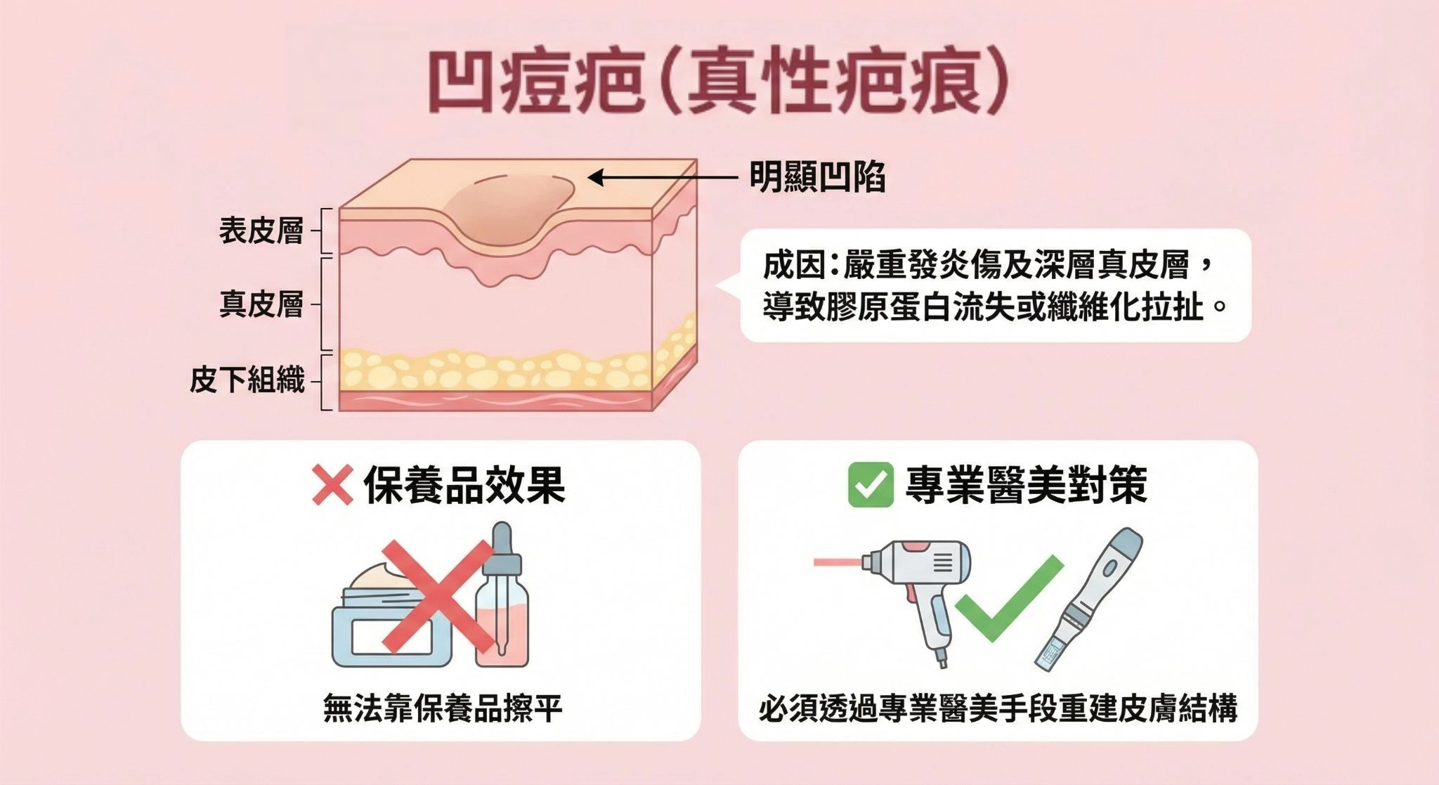 凹痘疤（真性疤痕）