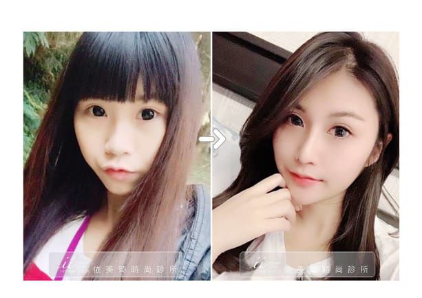 台南隆鼻成功案例分享