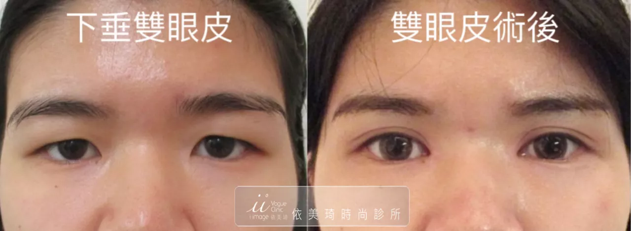 下垂雙眼皮