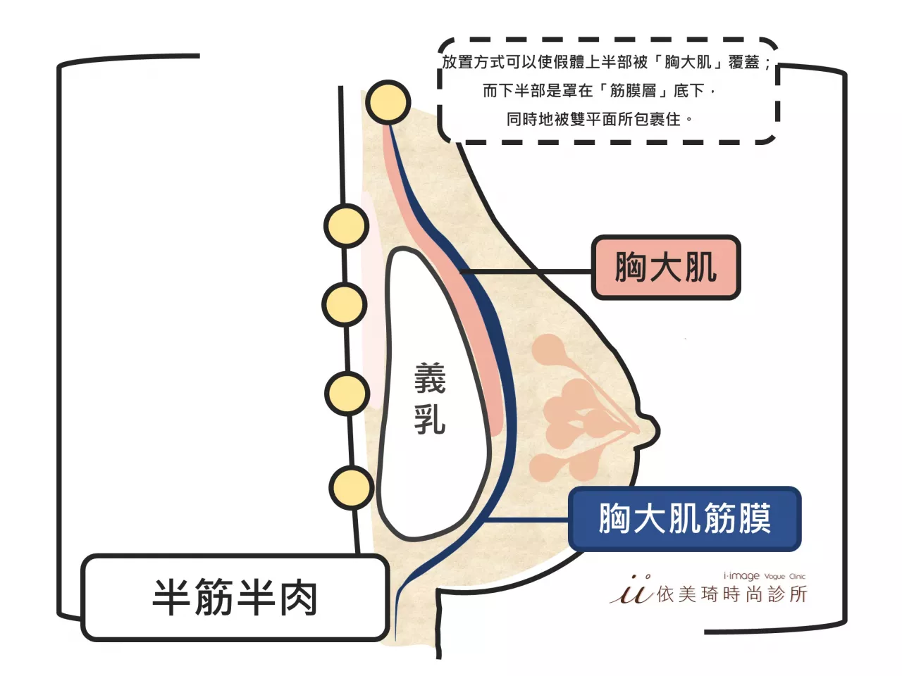 隆乳假體放置半筋半肉位置|隆乳手術多少錢？｜隆乳手術危險嗎？｜隆乳手術前注意事項｜隆乳術後照顧｜隆乳手術過程