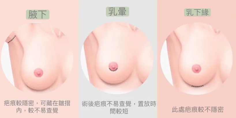 常見隆乳手術切口位置