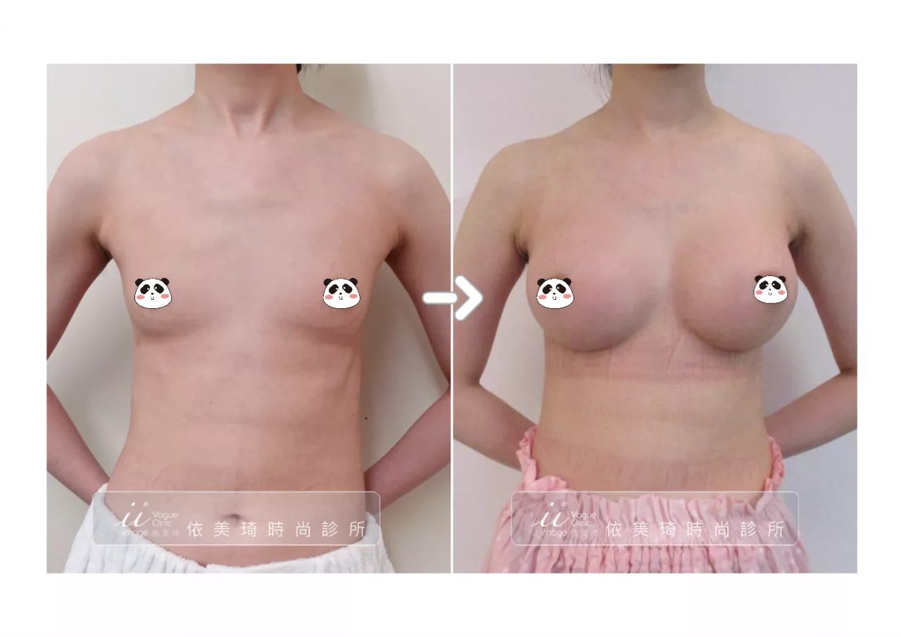 台南隆乳術後效果-曼陀女王波隆乳假體