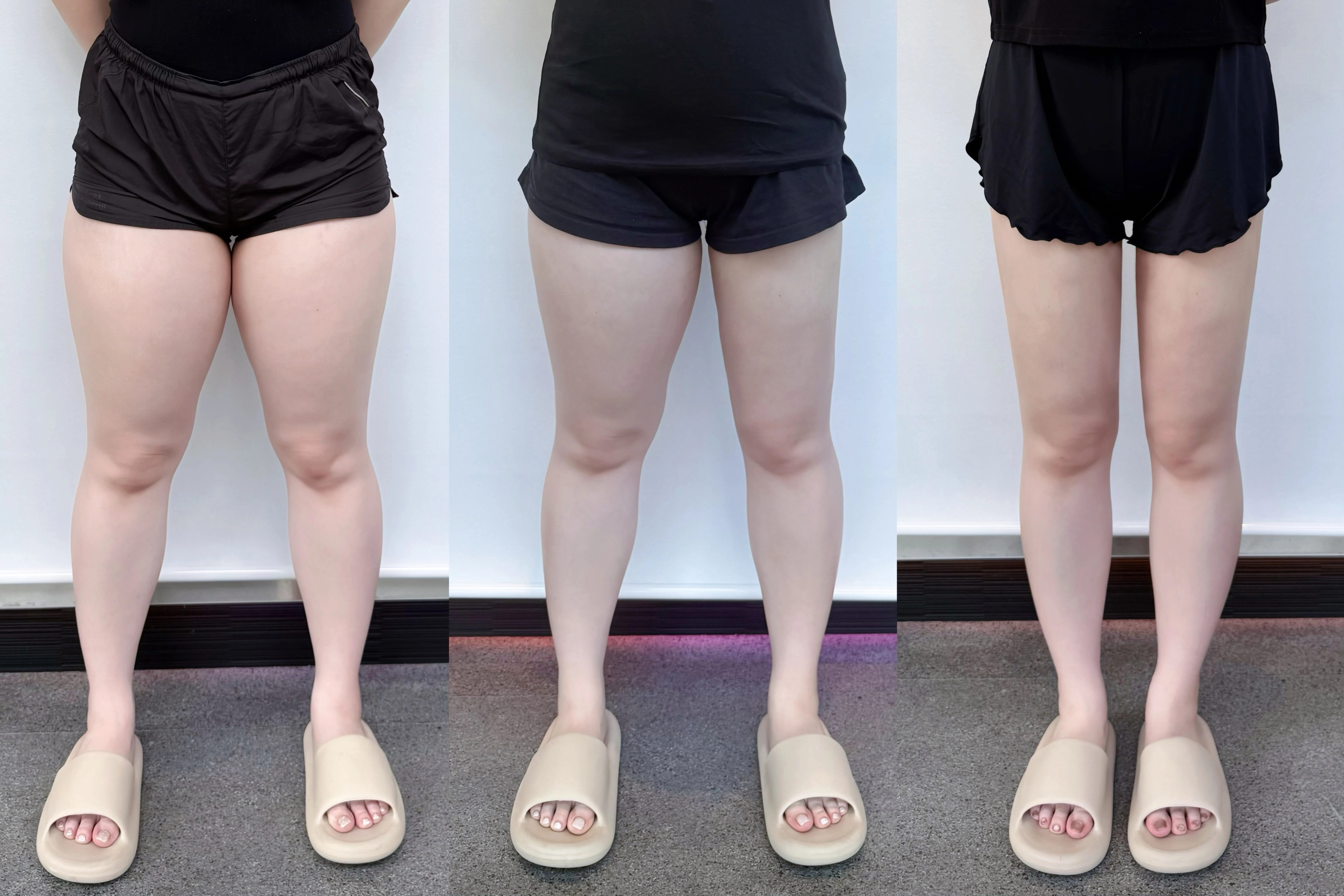 大腿抽脂實際成果對比照