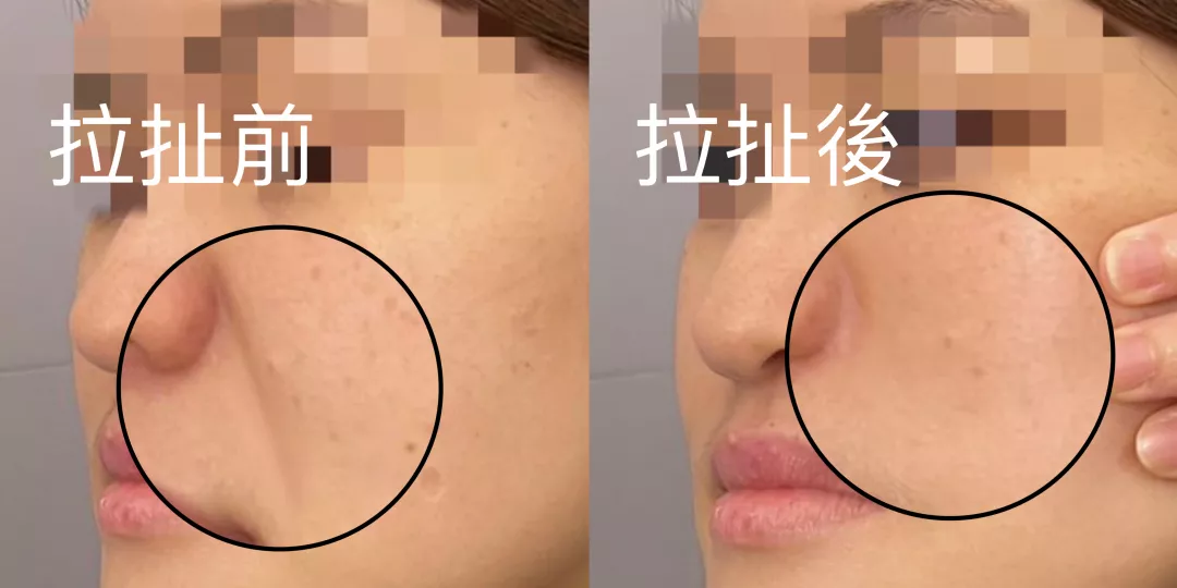 鬆垂型法令紋