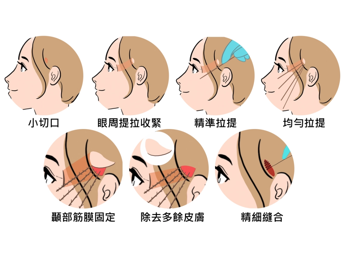 皺紋破解法隱痕筋膜拉提