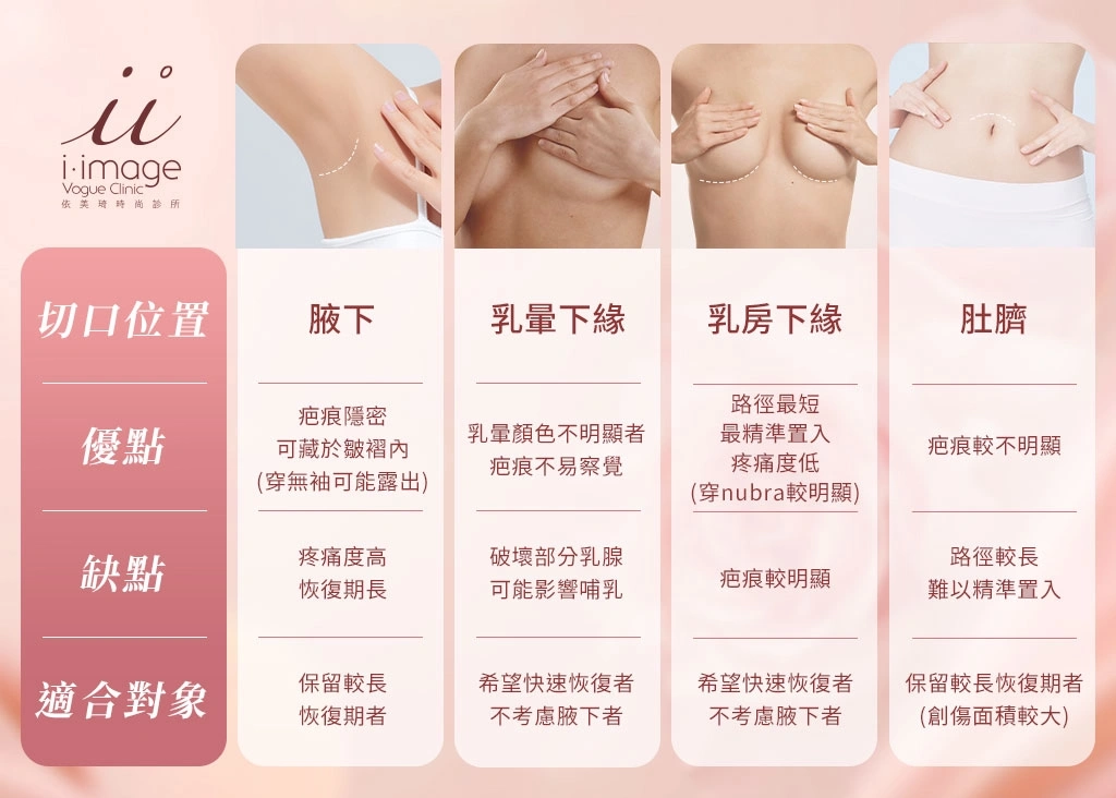 隆乳常見切口位置