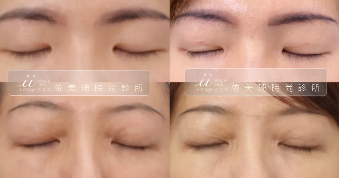 QQ無痕雙眼皮疤痕