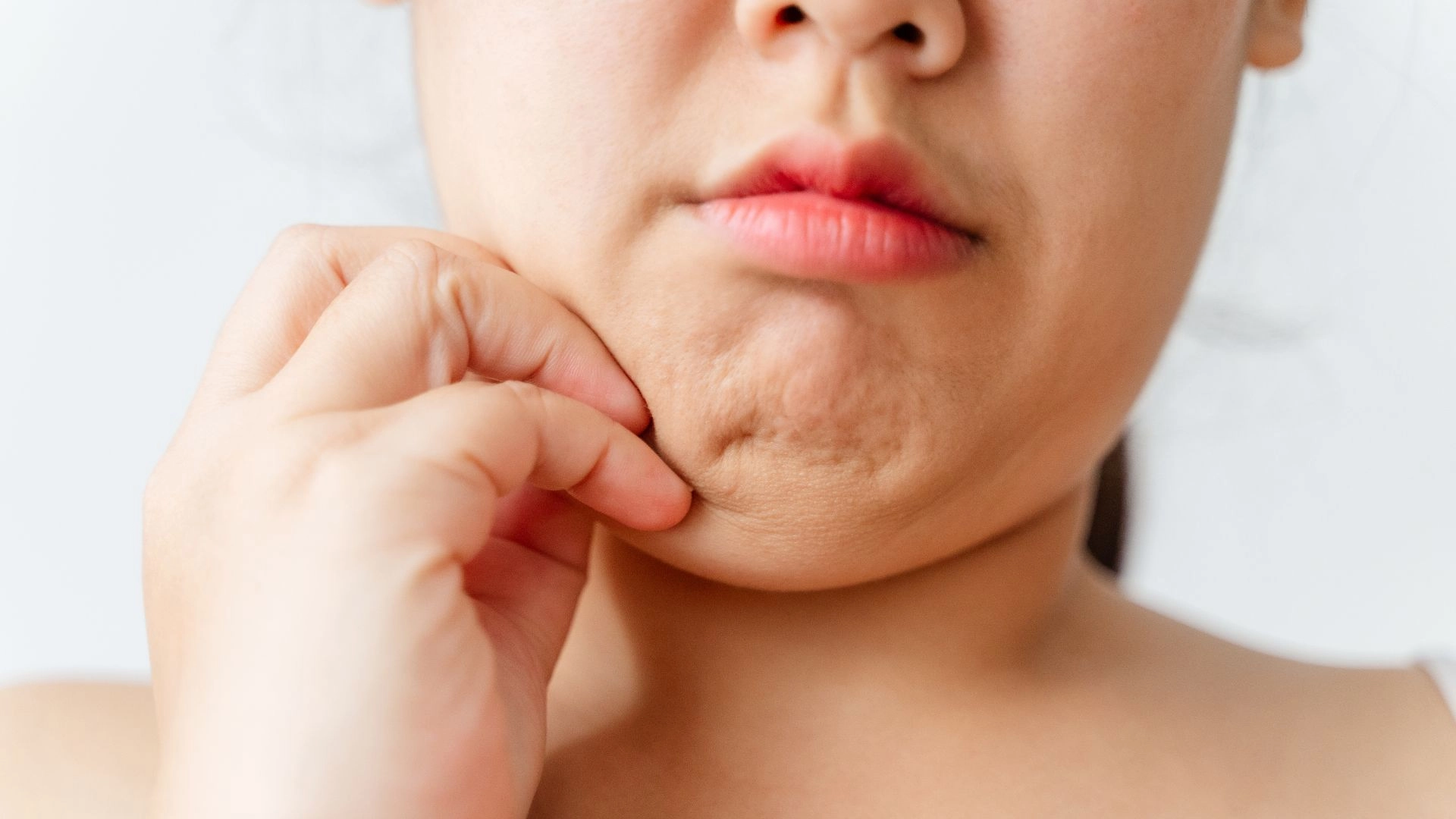 目前消脂針核准的適應症只限於「 雙下巴（ 下頦脂肪 ） 」