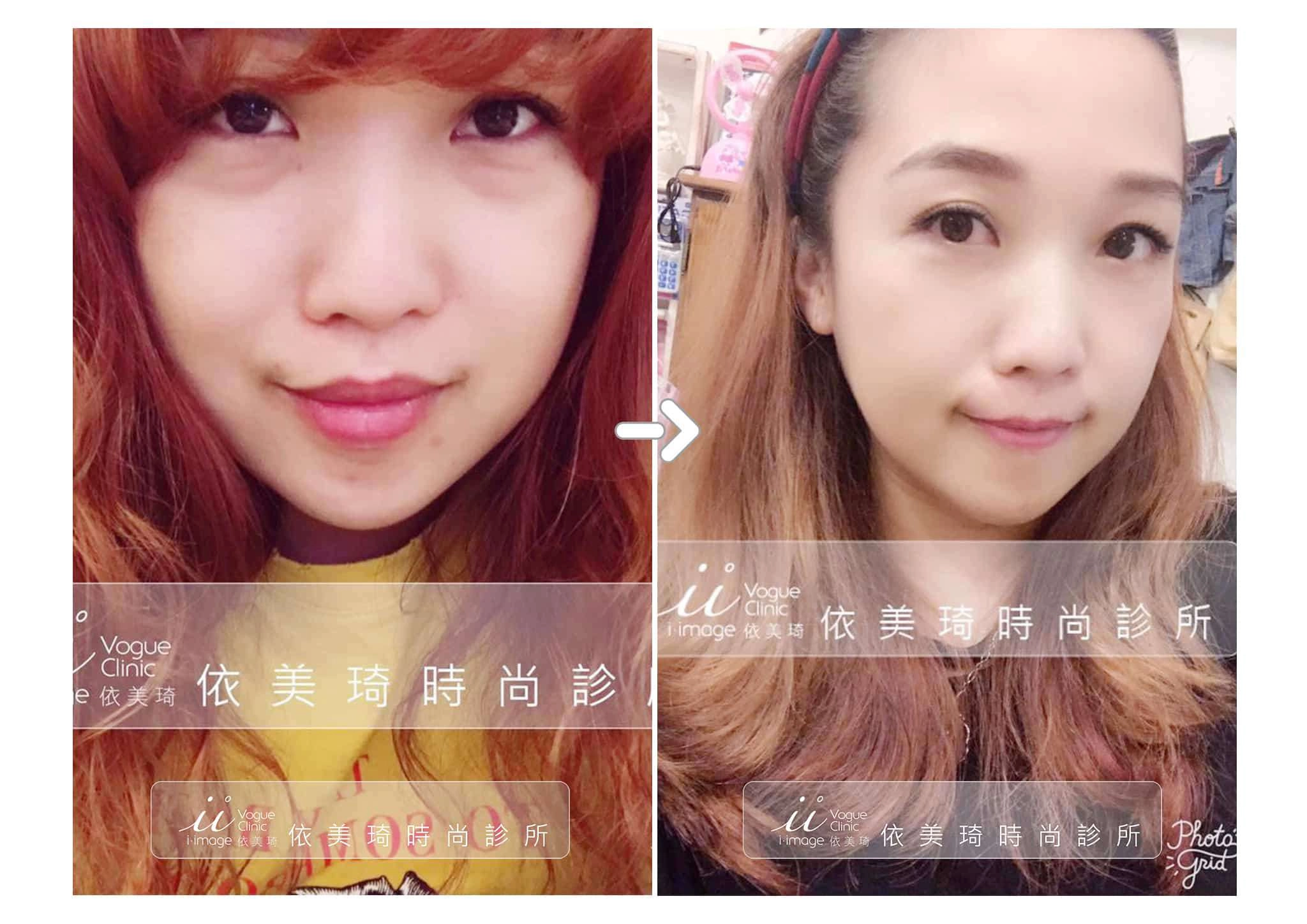 眼袋案例分享
