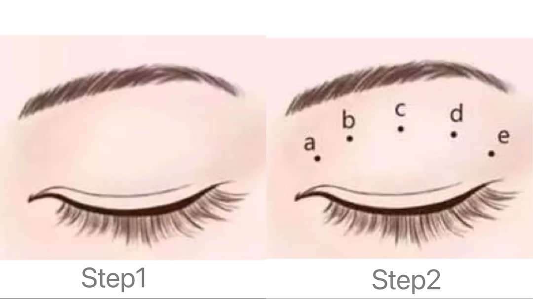 雙眼皮手術方式