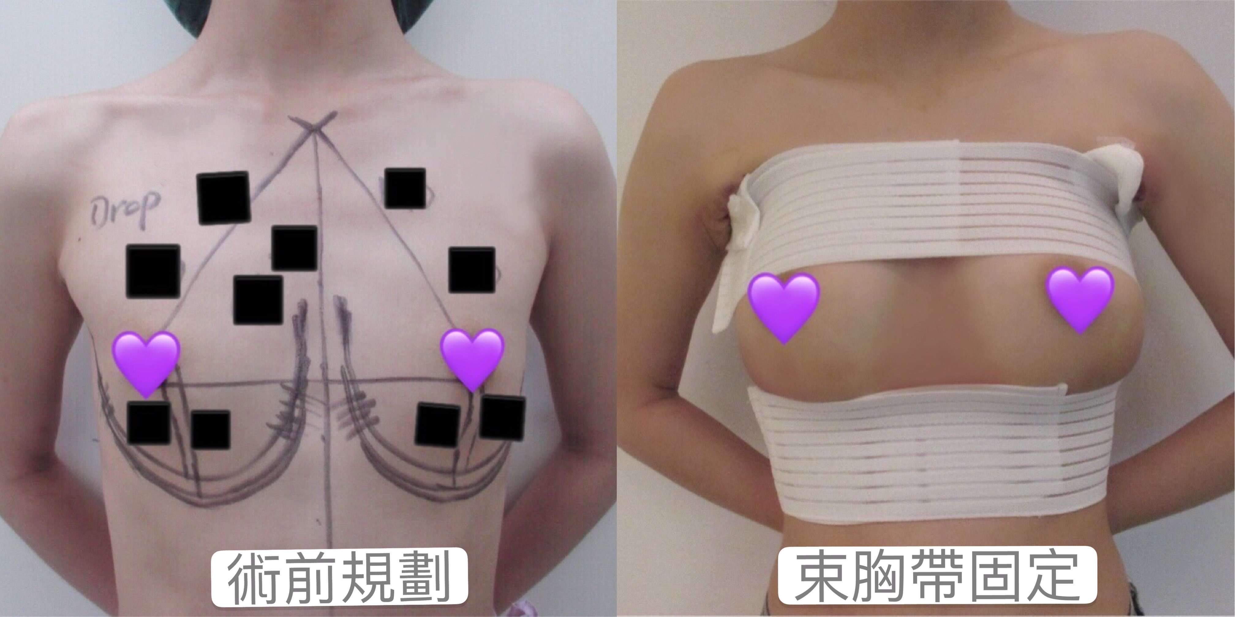 隆乳手術前規劃與束胸帶固定
