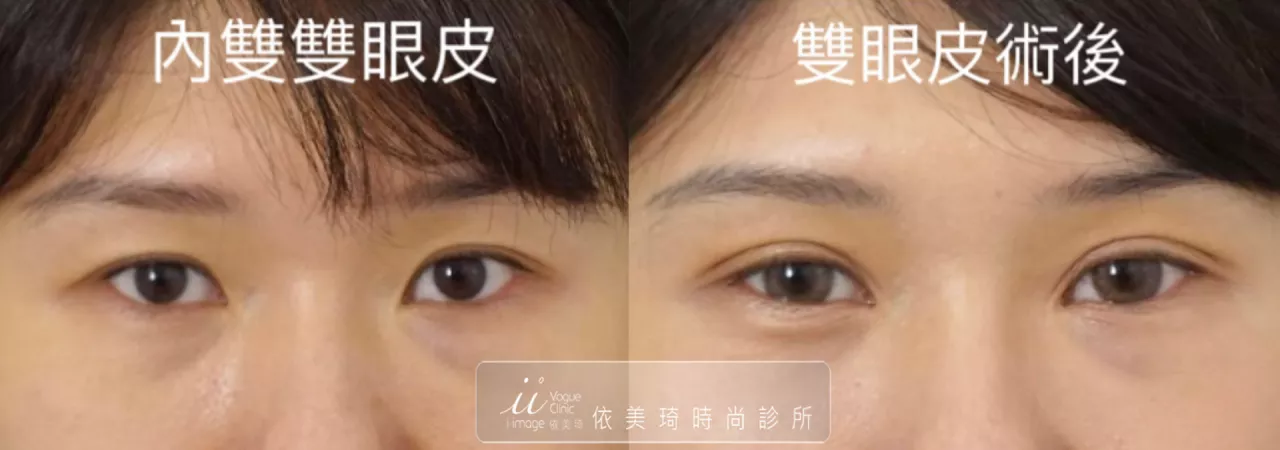 內雙雙眼皮
