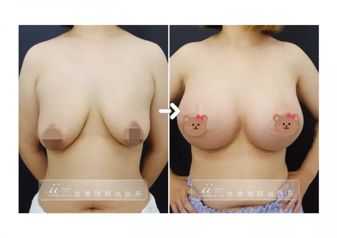 隆乳＋提乳手術案例照（正面）