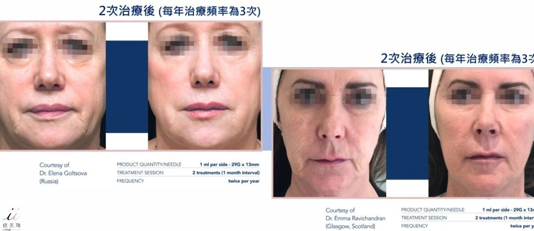 Profhilo 逆時針實際案例