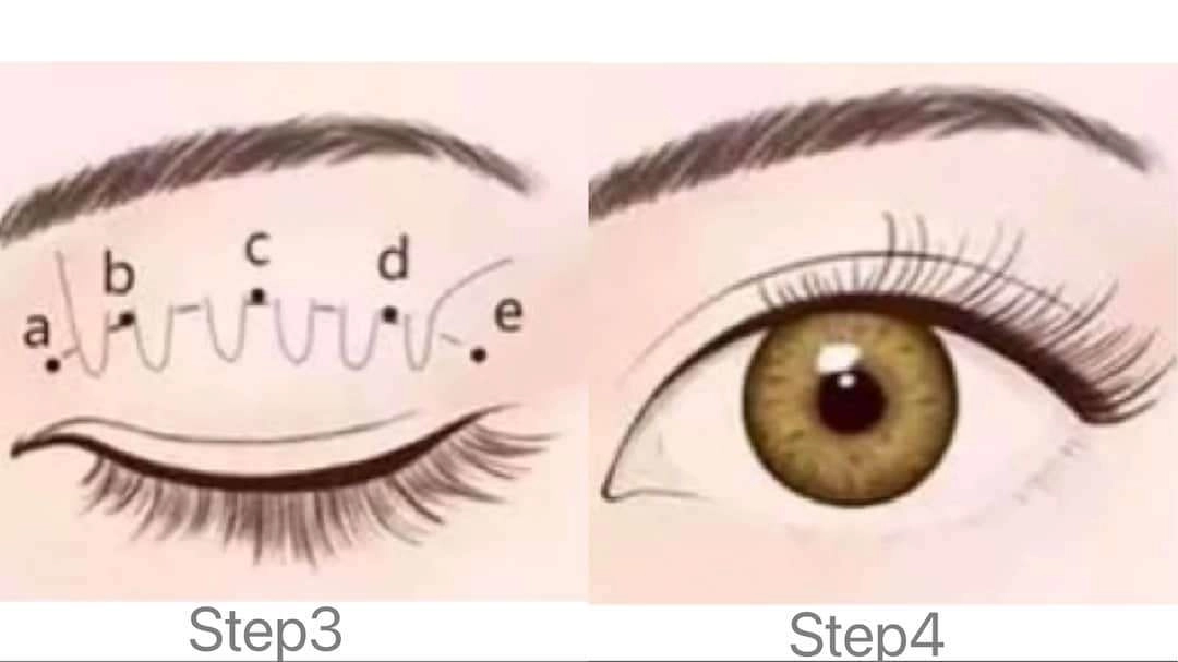 雙眼皮手術方式step3~4