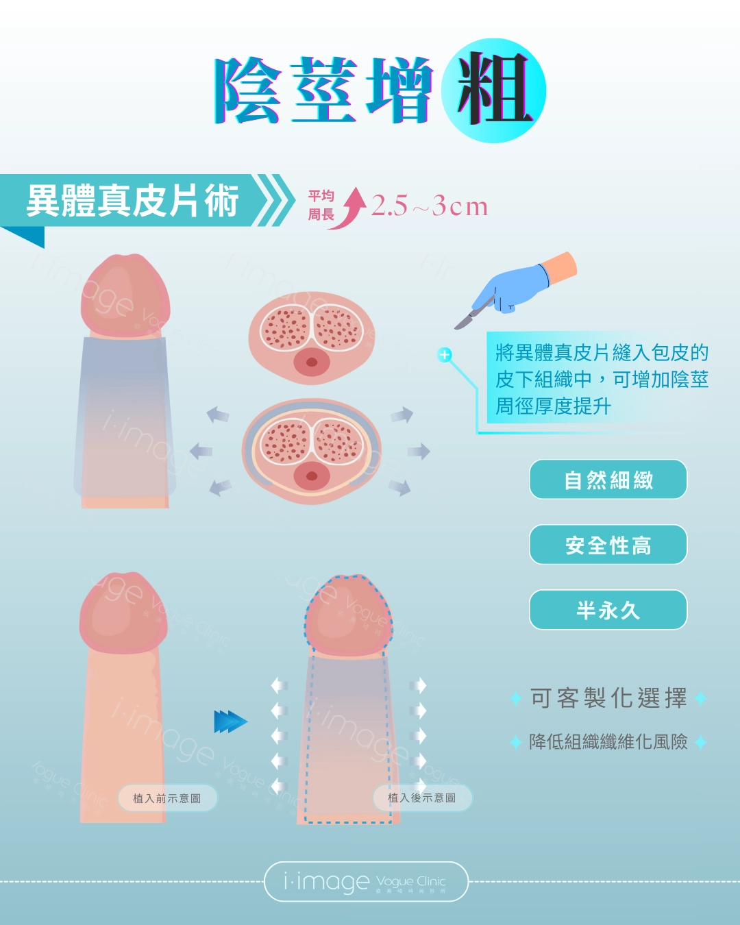 陰莖增粗-異體真皮片術