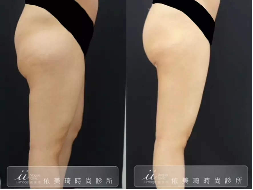 手臂抽脂案例分享-大腿側面-1