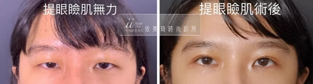 提眼瞼肌無力