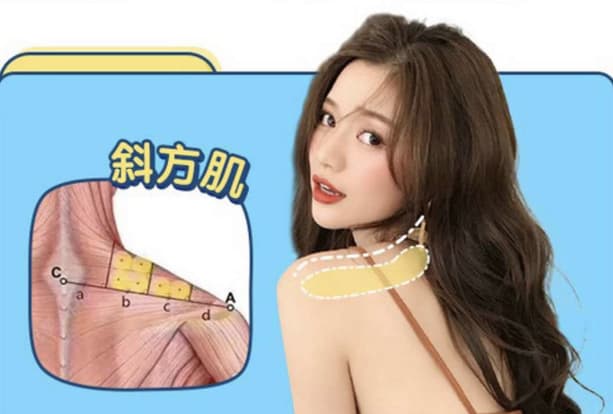 肉毒打斜方肌