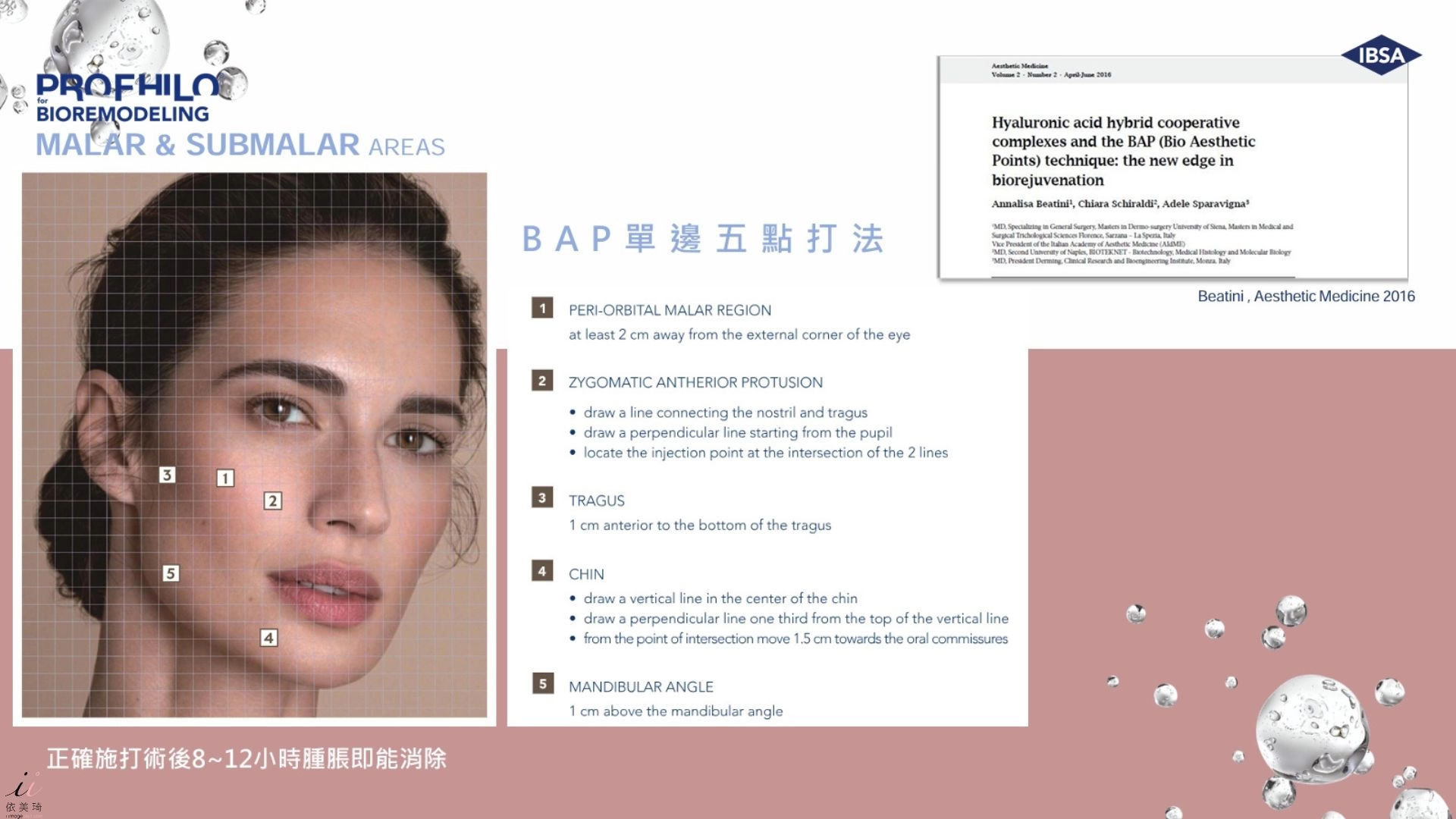 Profhilo逆時針五點打法示意圖