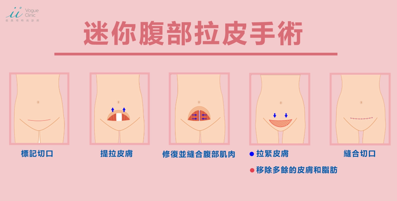 迷你腹部拉皮手術（Mini Abdominoplasty）是一種針對下腹部的外科整形手術