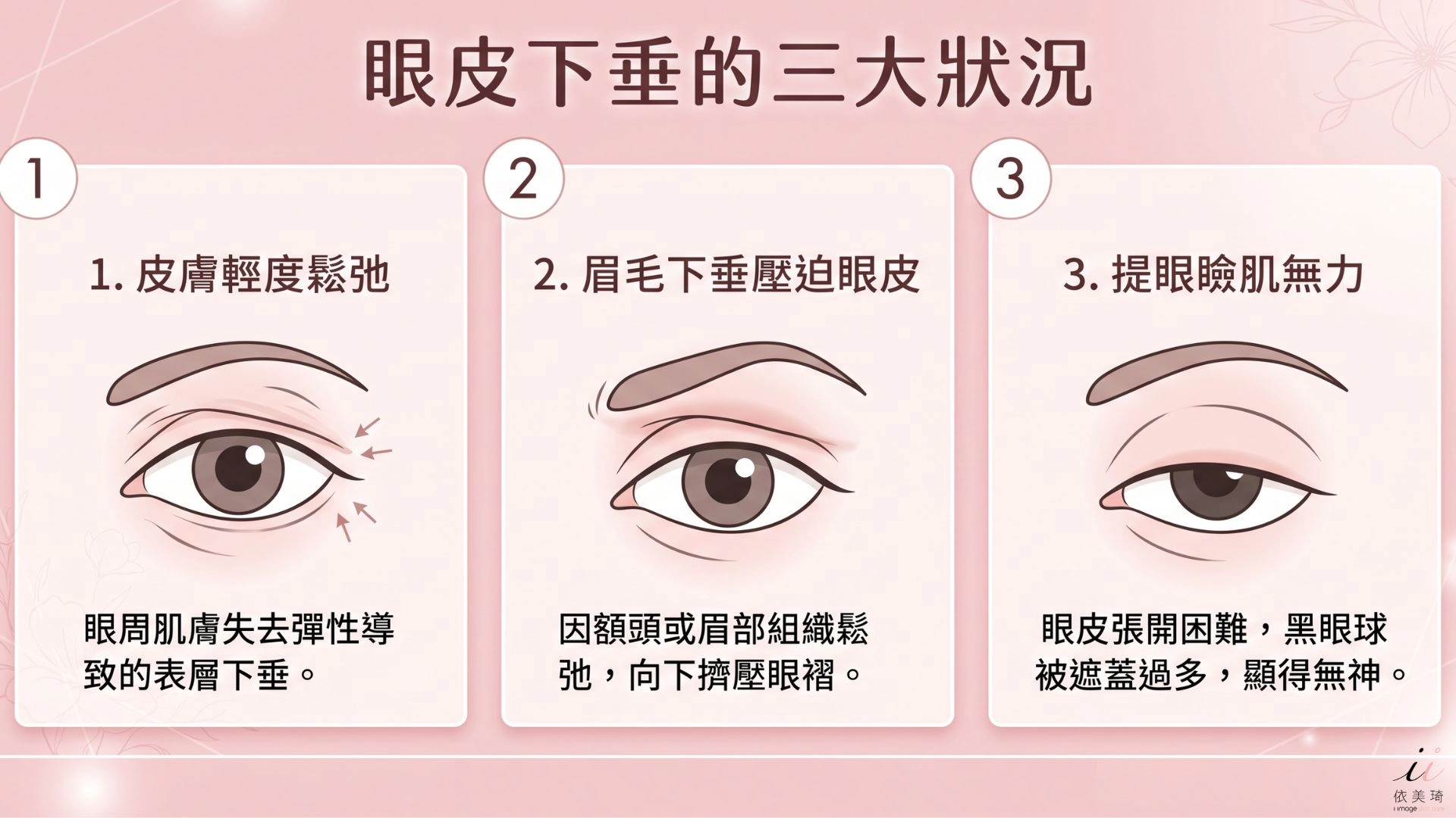 眼皮下垂一定要開刀嗎？先看你是哪種狀況