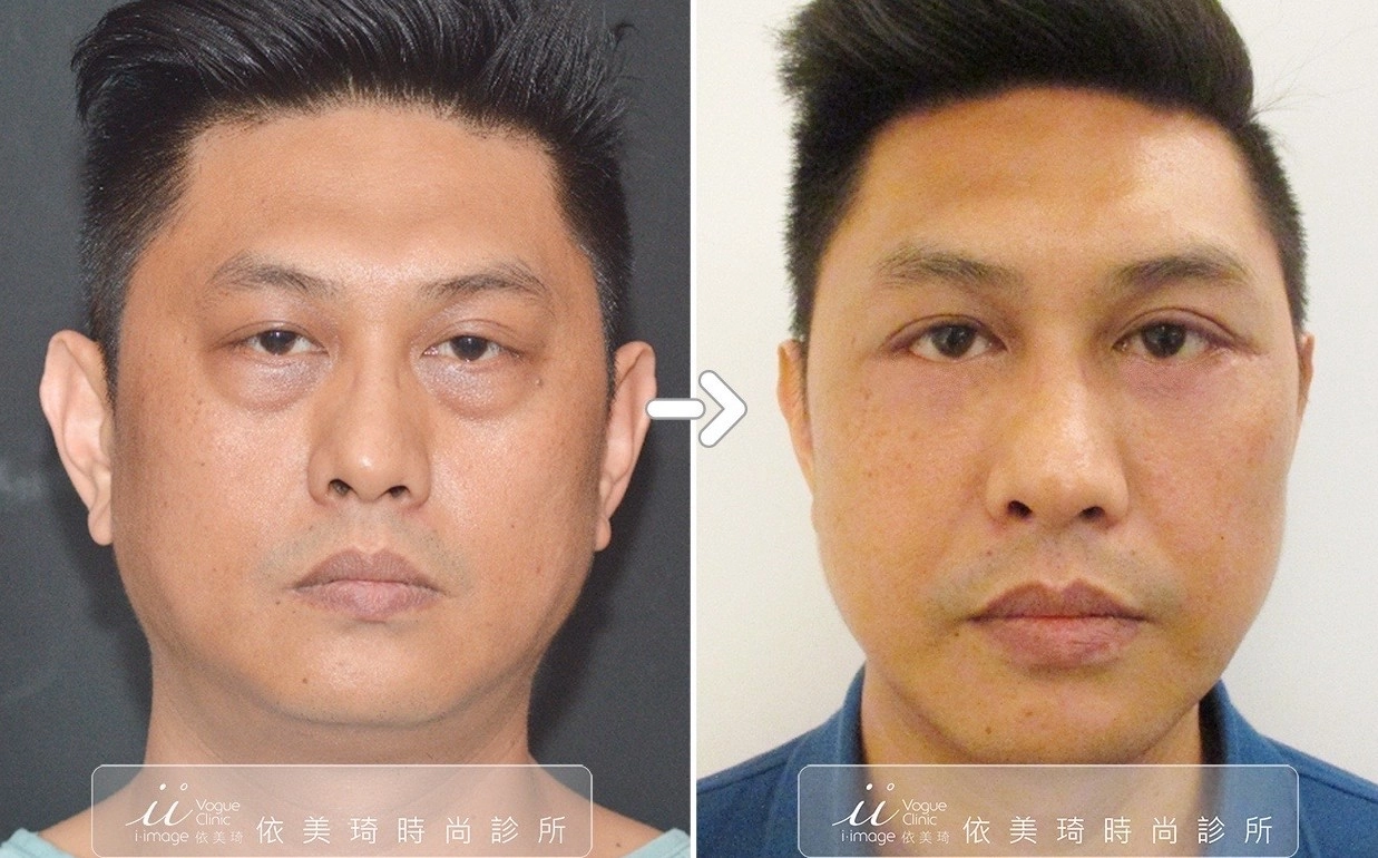 眼袋外開手術案例