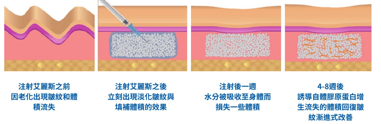 精靈針會立刻見效嗎？膠原蛋白增生需要多久？